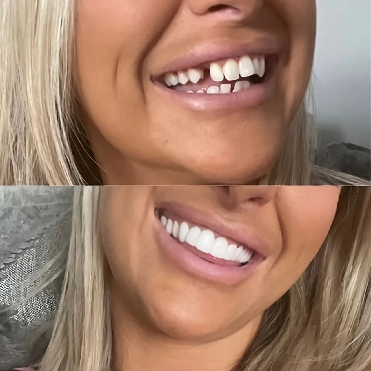 TryAnnie™ Clip-on Veneers