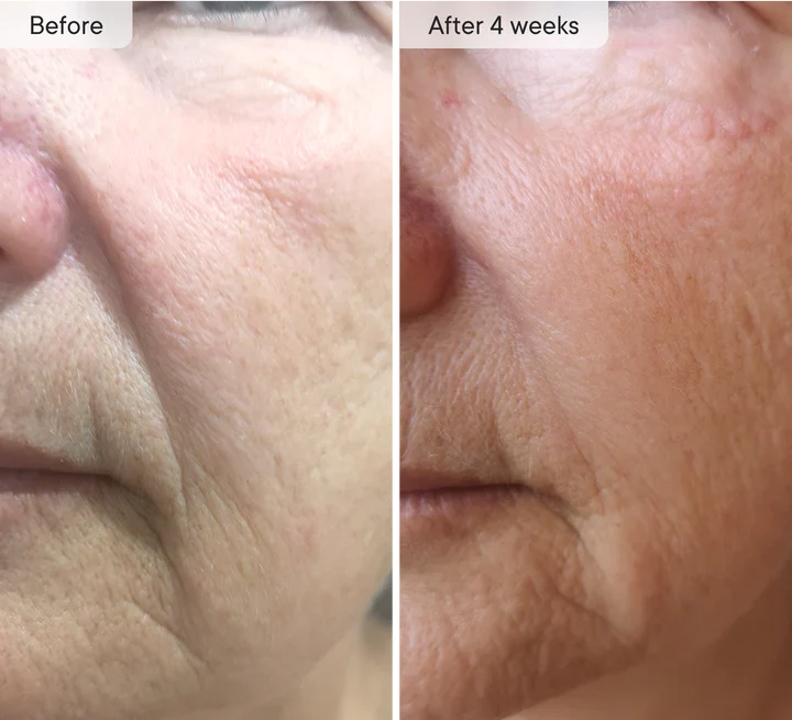 Microneedle Under-Eye Patches