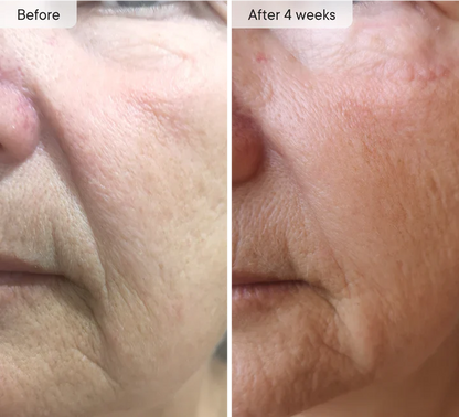 Microneedle Under-Eye Patches