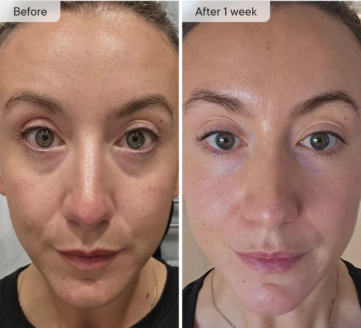 Microneedle Under-Eye Patches