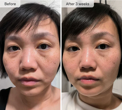 Microneedle Under-Eye Patches